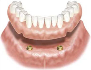 full-arch-implant-over-denture